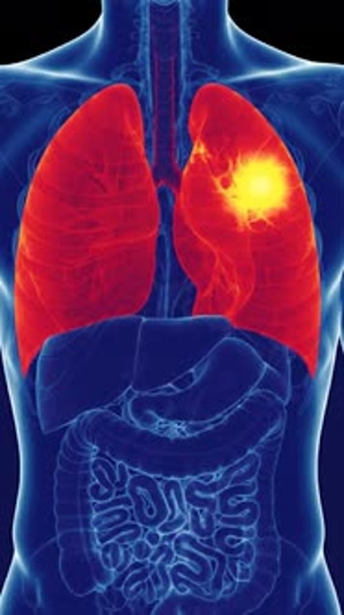 Lung Cancer Detection - Pet Scan Thermal View 3d Medical Animation | Manestream Den