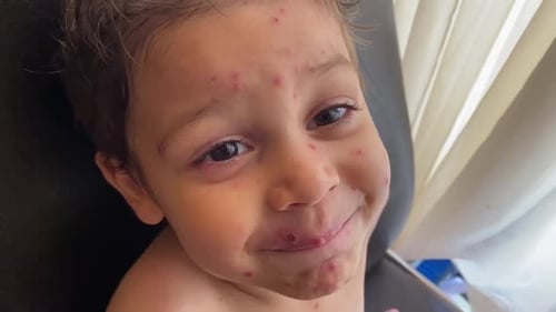 Child with Spots Smiling Close Up Indoors
