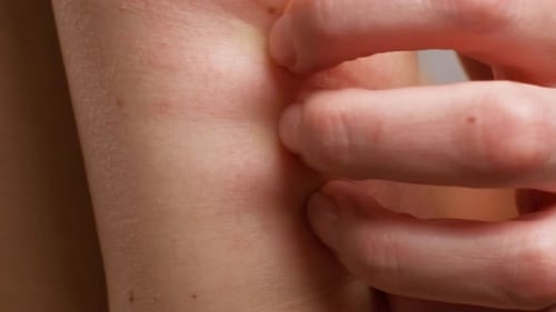Die Hand einer Frau kratzt an einer entzündeten Stelle auf der mit Blasen bedeckten Haut