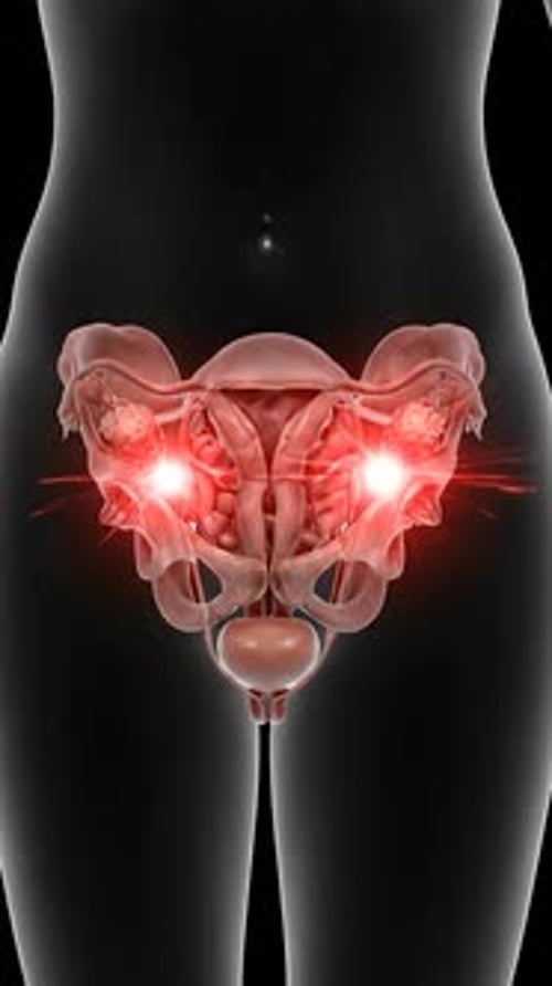 Pelvic Pain - Uterine & Ovarian Nerve Pathways 3D Medical Animation | Manestream Den