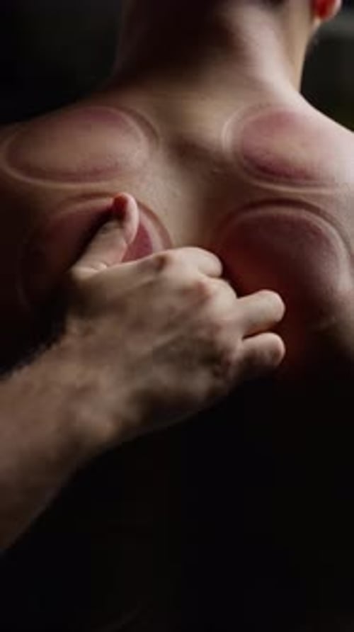 Man's Back after Cupping Therapy, Massage