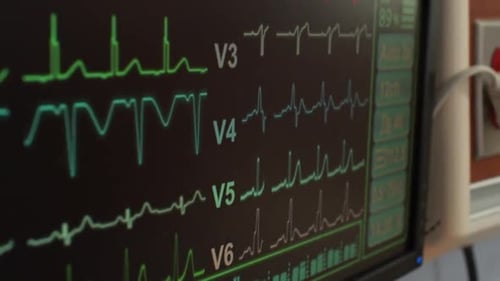 Electrocardiogram - heart monitor