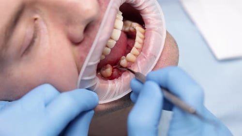Preparation Gums Before Installing a Healing Abutment Often Referred to As a Healing Cap or Gingival