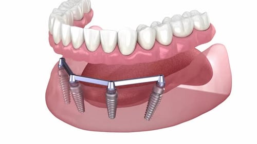 Dental Implant Supported Prosthesis Installation 3D Animation