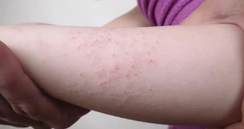 Red Allergy Rash Dermatitis on Baby Hand Close Up