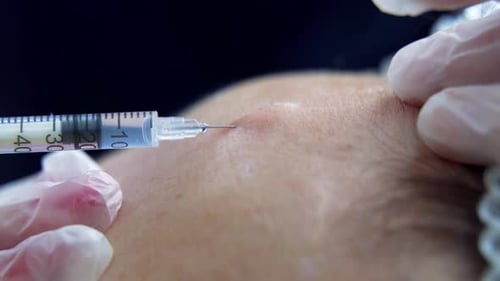 Injection Given in Forehead Close Up
