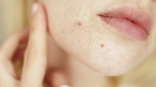 Problems face skin with acne and enlarged pores. Woman touching her face with a pimple