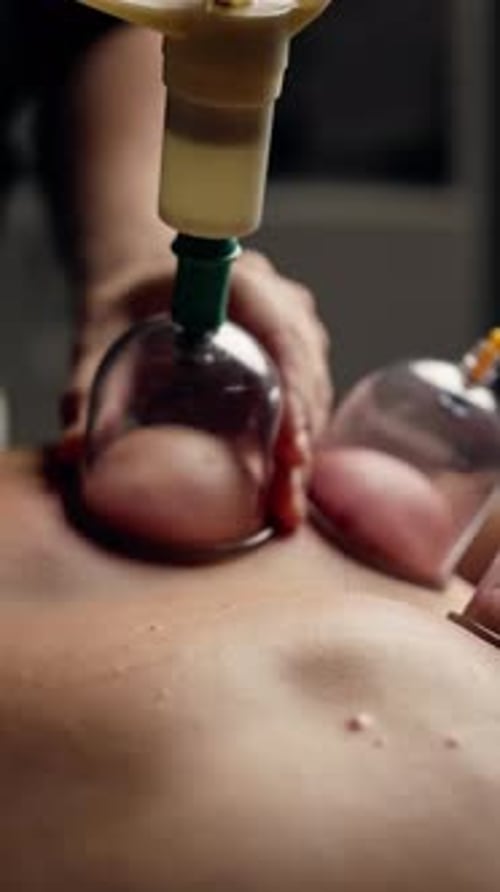 Cupping Therapy on Back Using Glass Cups