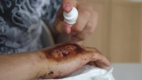 close up disinfecting wound on a hand