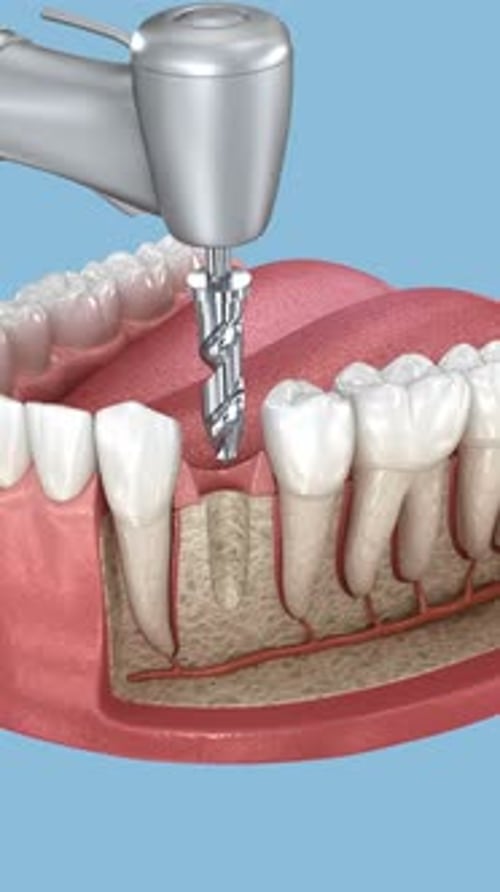 Instalación de implantes dentales y coronas cerámicas. Animación 3D