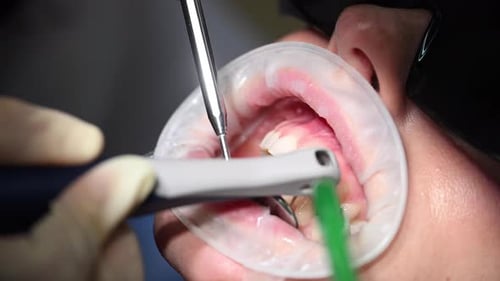 Dental Extreme Close Up Macro Video Dental Cleaning Process in Patient Mouth Clean Teeth and Gums