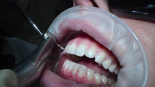 Processus de nettoyage vidéo macro Dental Extreme Close Up dans la bouche du patient : nettoyez les dents au jet d'eau