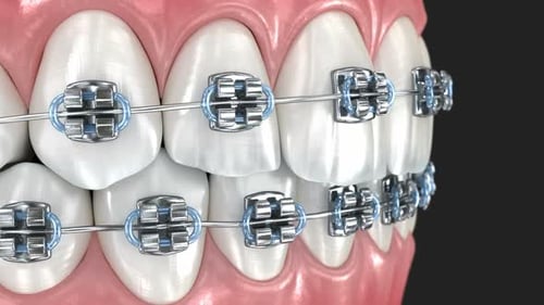 Teeth Braces Orthodontic Correction 3D Animation