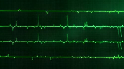 Heartbeat ECG Monitor Animation – Medical Electrocardiogram Vital Sign Background Loop