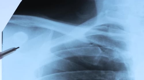 Dislocation of the acromial