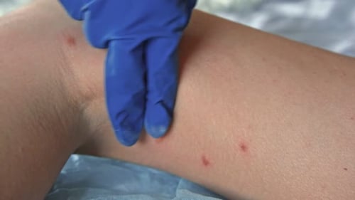Arzt untersucht Teenager-Mädchen mit körperlichem roten Hautausschlag Allergie Nahaufnahme Teenager kratzt Eruption Krankenschwester