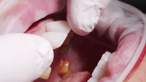 Dental Crown Being Fitted in Close Up