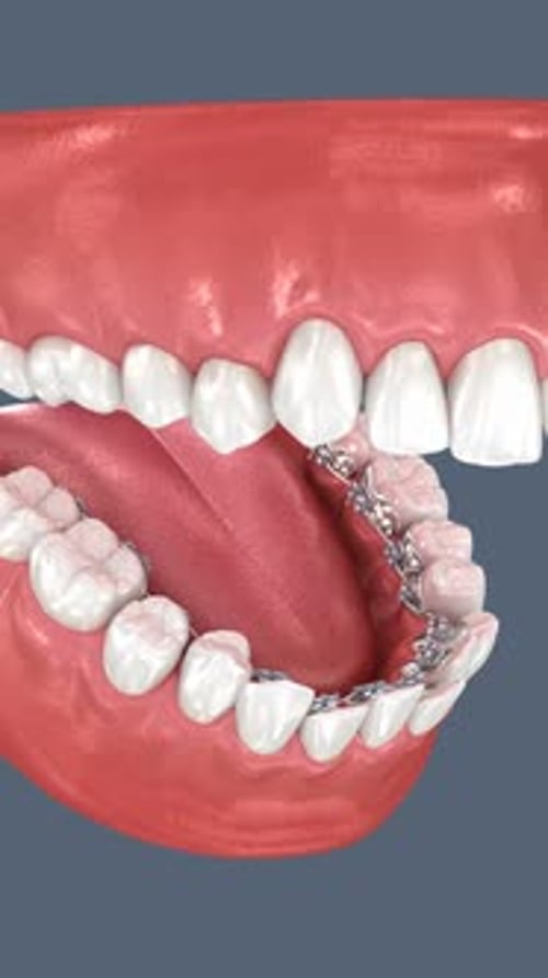3D Animation of Teeth Alignment with Braces Orthodontic Correction