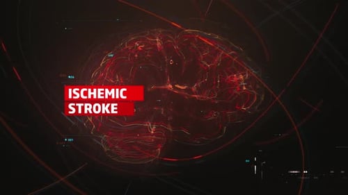 Medical Data Visualization of Ischemic Stroke in a Digital Brain