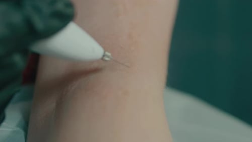Cauterizing Skin With Needle Close Up