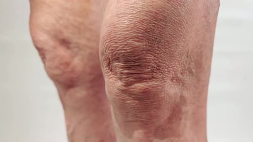 Wrinkled Knees of Elderly Woman
