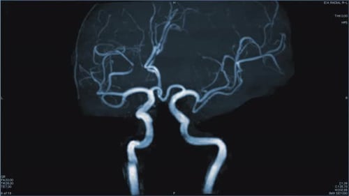 Magnetic Resonance Images of the Brain MRI of the Brain of a Patient with Multiple Vascular