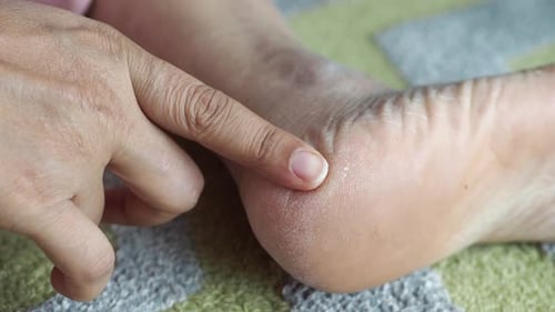 Close Up of Young Women Dry Feet