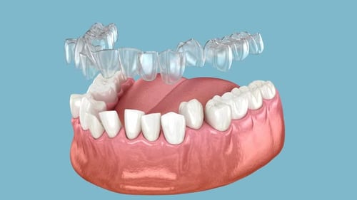 3D Animation of Teeth Alignment with Clear Aligner