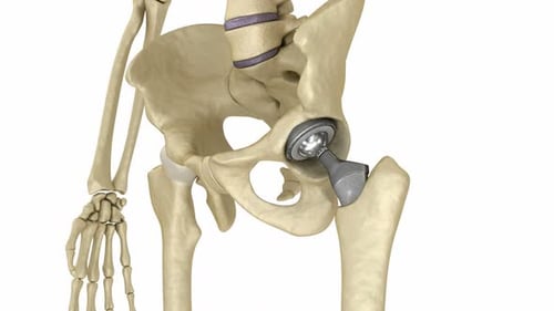 Human Skeleton Total Hip Replacement 3D Animation