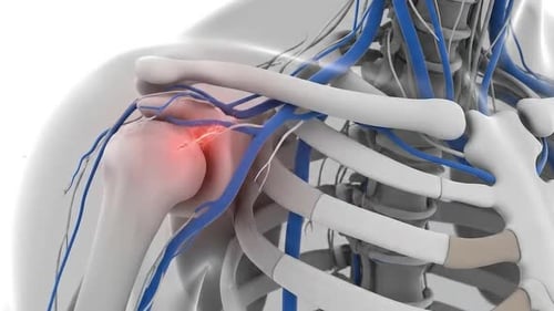Medical Animation of Human Shoulder Pain and Relief