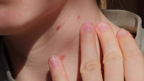 Birthmarks on Skin Close Up Detail of the Bare Skin Sun Exposure Effect on Skin Health Effects of UV