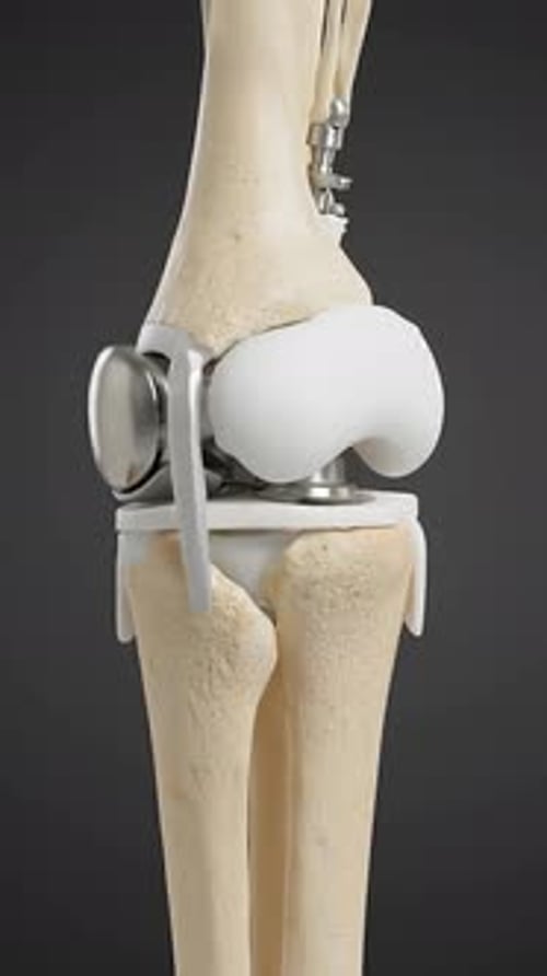 Knee Replacement - Prosthetic Joint Implant 3D Medical Animation | Manestream Den