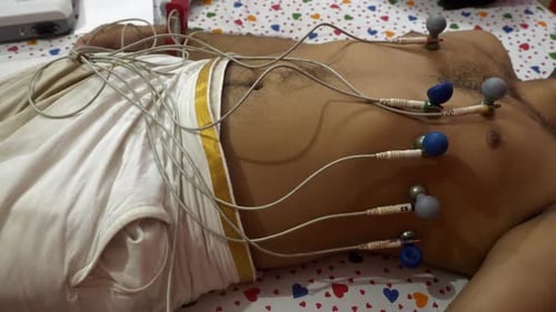 ECG electrodes attached to patient's chest, arms, and legs to record heart electrical signal