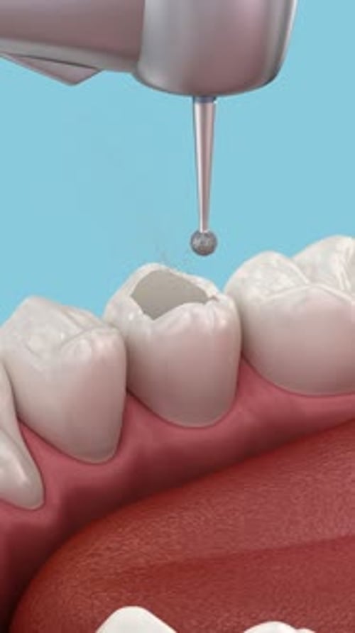 Endodontic root canal treatment process. Medically accurate tooth 3D animation