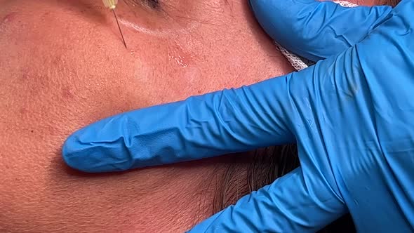 La toxina botulínica se inyecta en el músculo orbicularis oculi para el ...