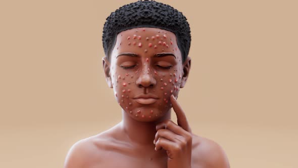 Animated 3D Visual of Person with Acne Skin Condition, Backgrounds ...