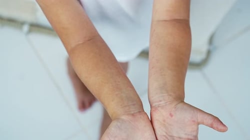Entérovirus (jambe, bras, bouche)