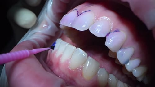 Woman at Dental Chair in Dental Clinic Dental Extreme Close Up Macro Video Cleaning Process in