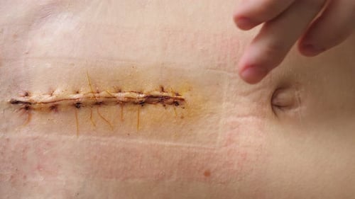Abdomen of Young Girl Closeup Video of the Long Scar Above Navel After Abdominal Surgery for