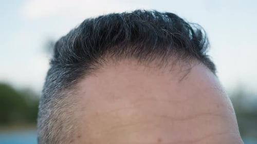 Hair Of A Man With Starting Baldness