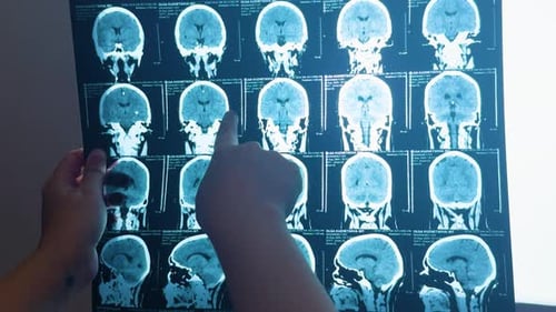 Doctor hands examining and pointing at a ct brain scan on lightbox, highlighting