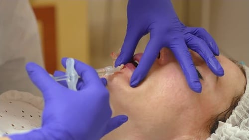 Labios lesionados y ensangrentados durante el agrandamiento con ácido hialurónico y relleno en un salón de belleza
