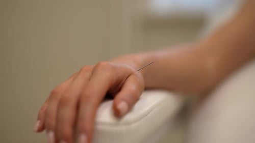 Primer plano de una clienta relajada que recibe un procedimiento de acupuntura corporal acostada en China Medical