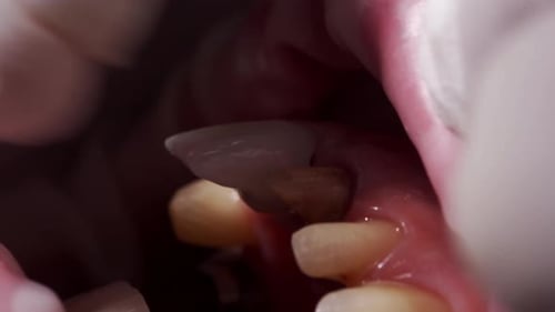 Installing a Dental Veneer in Macro Shot