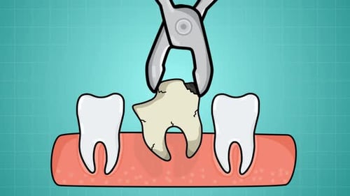 Flat Design Animation of Dental Tooth Extraction Process