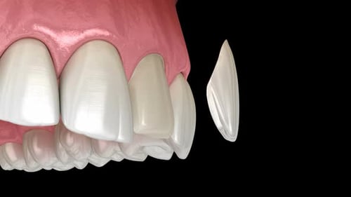 Veneer installation procedure over central incisor.