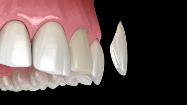 Veneer installation procedure over central incisor. , Backgrounds ...