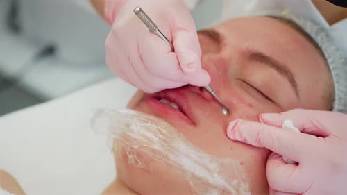 Aesthetician Extracts Blemishes on Patient's Face Close Up