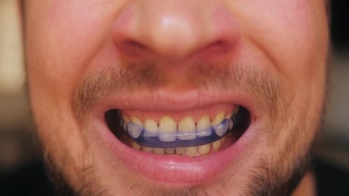 Dental Teeth Aligner and Night Guard Orthodontic Braces Close Up