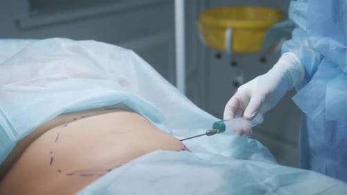 Liposuction Procedure Focusing on Abdominal Area with Medical Professional Preparing for Surgery